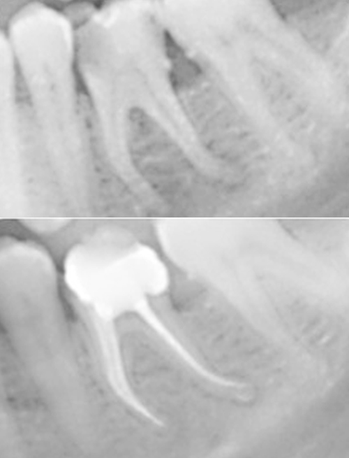 rootcanal